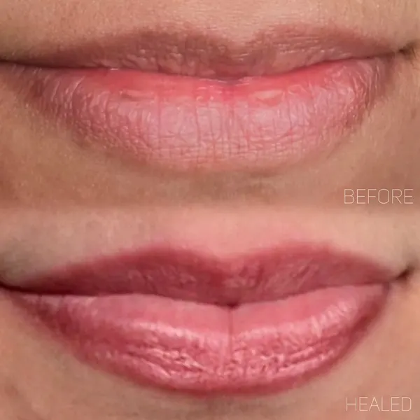 Darker lips before, above, and neutralised healed lips, below