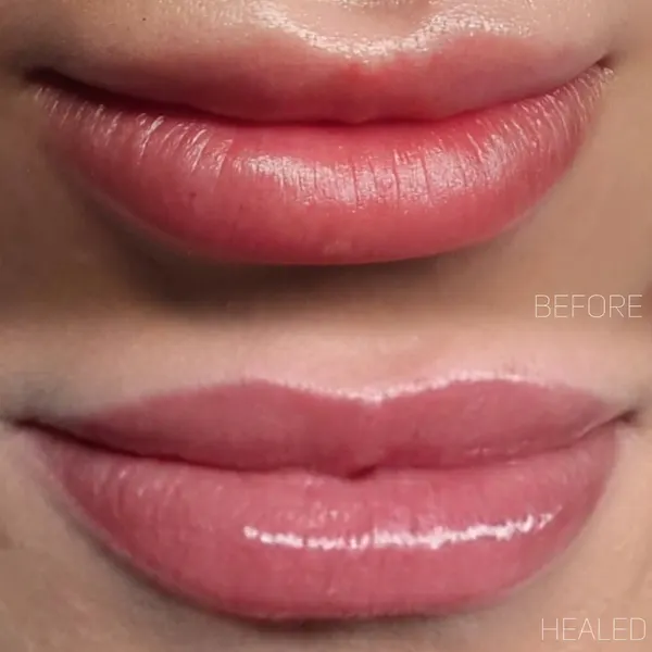 Lips before and healed, showing a refined cupid’s bow